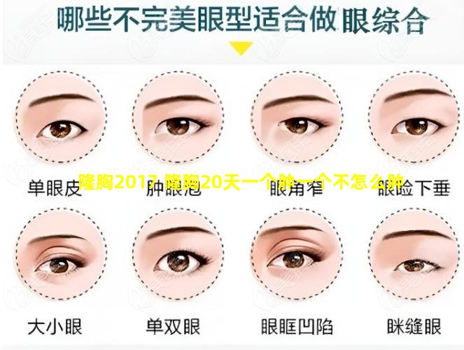 隆胸2017 隆胸20天一个肿一个不怎么肿